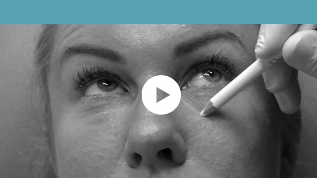 facial indications | middle third - tear troughs