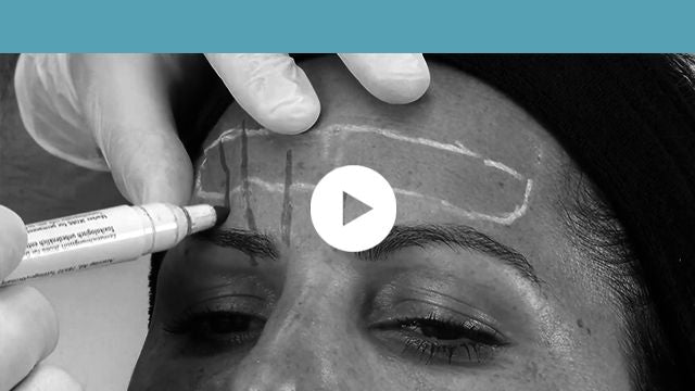 facial indications | upper third - glabella and horizontal forehead lines