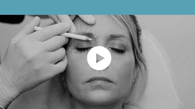 facial indications | upper third - superior orbital sulcus