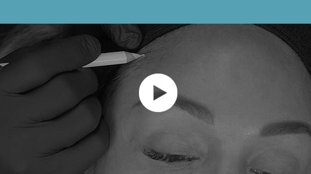 facial indications | upper third - forehead lift