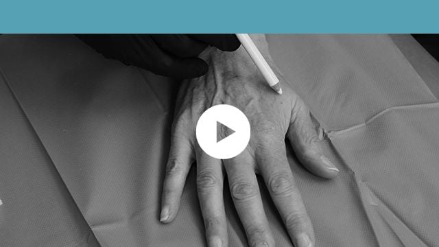 soft tissue fillers: non-facial indications