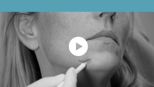 facial indications | lower third - marionette lines, pre-jowl sulcus and oral commissures