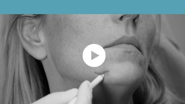 soft tissue fillers: facial indications - lower third