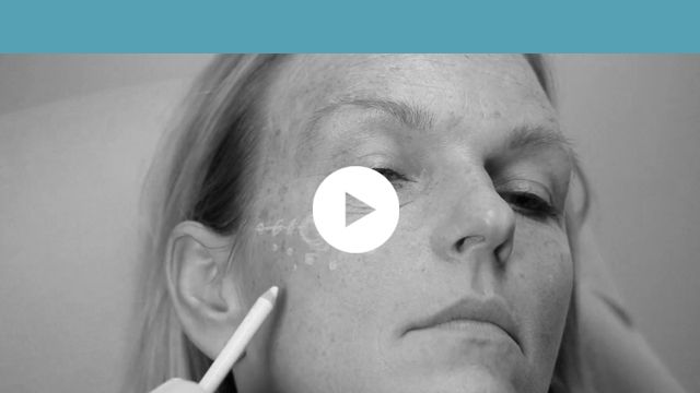 facial indications | middle third - skin quality improvement of the cheeks