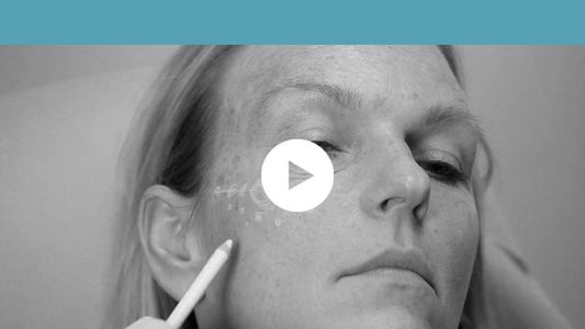 facial indications | middle third - skin quality improvement of the cheeks