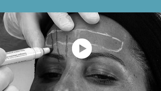 facial indications | upper third - glabella and horizontal forehead lines