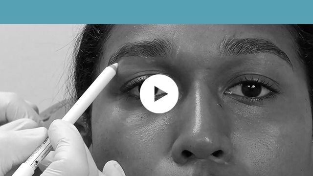 facial indications | upper third - brows