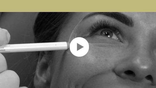 facial indications | upper third - periorbital wrinkles