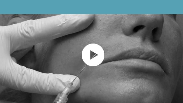 facial indications | middle third - nasolabial folds