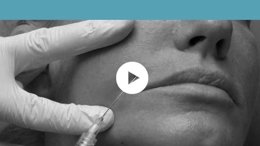 facial indications | middle third - nasolabial folds